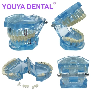 Заболяване на зъбни импланти Модел на зъбите с реставрационным мостовидным протеза Зъб за медицинската наука Стоматологичен Зъболекарски болест Научи да Учат Син